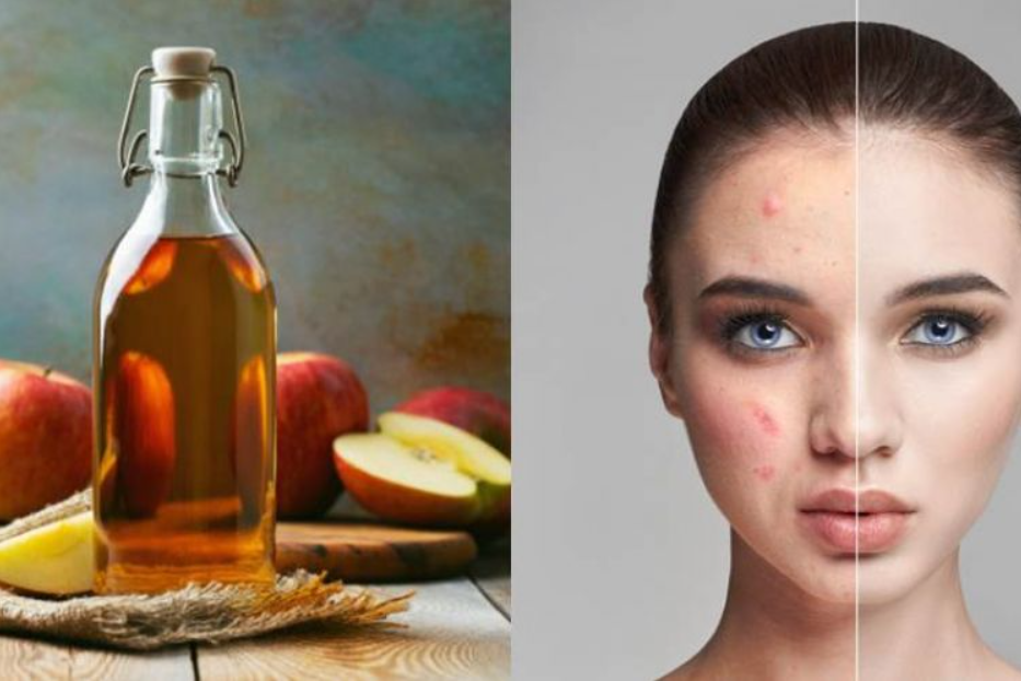 manfaat cuka apel untuk wajah dan cara menggunakannya