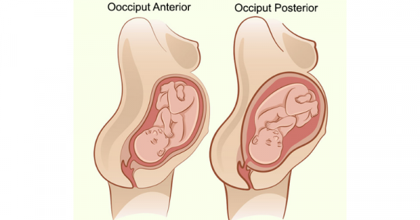 Cara Mengubah Posisi Bayi Posterior ke Anterior